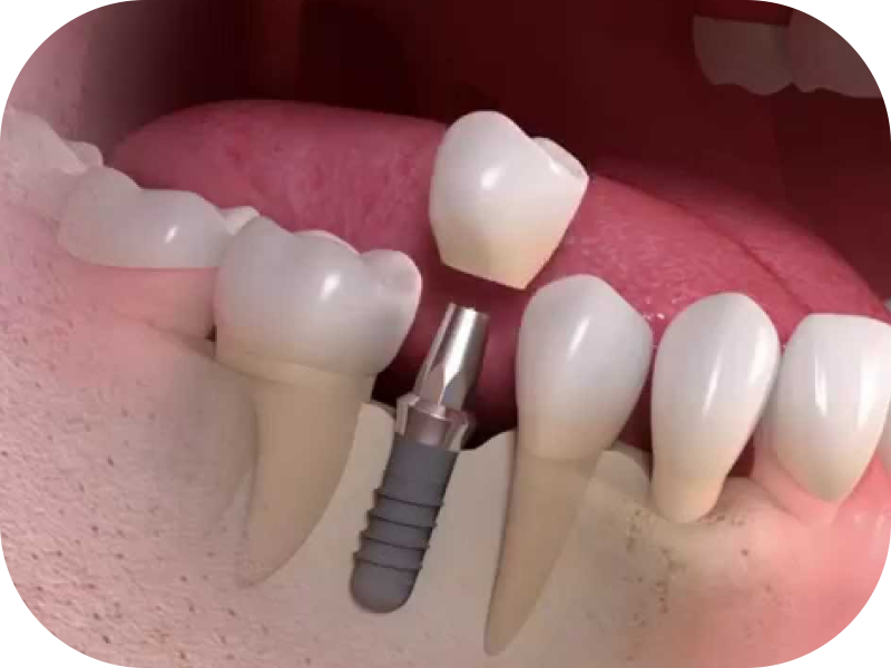 Implantes dentários