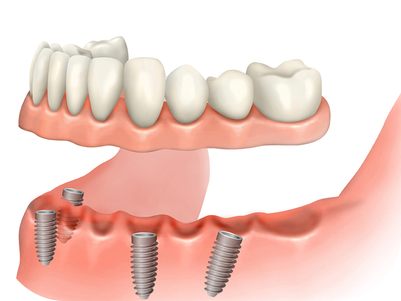 Prótese Sobre Implantes